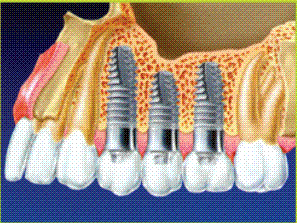 Примеры применения титано-танталовых имплантатов в зубном протезировании